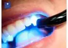 Affordable Brilliance: Teeth Whitening Cost NJ