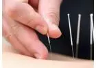 Acupuncture Therapy NYC